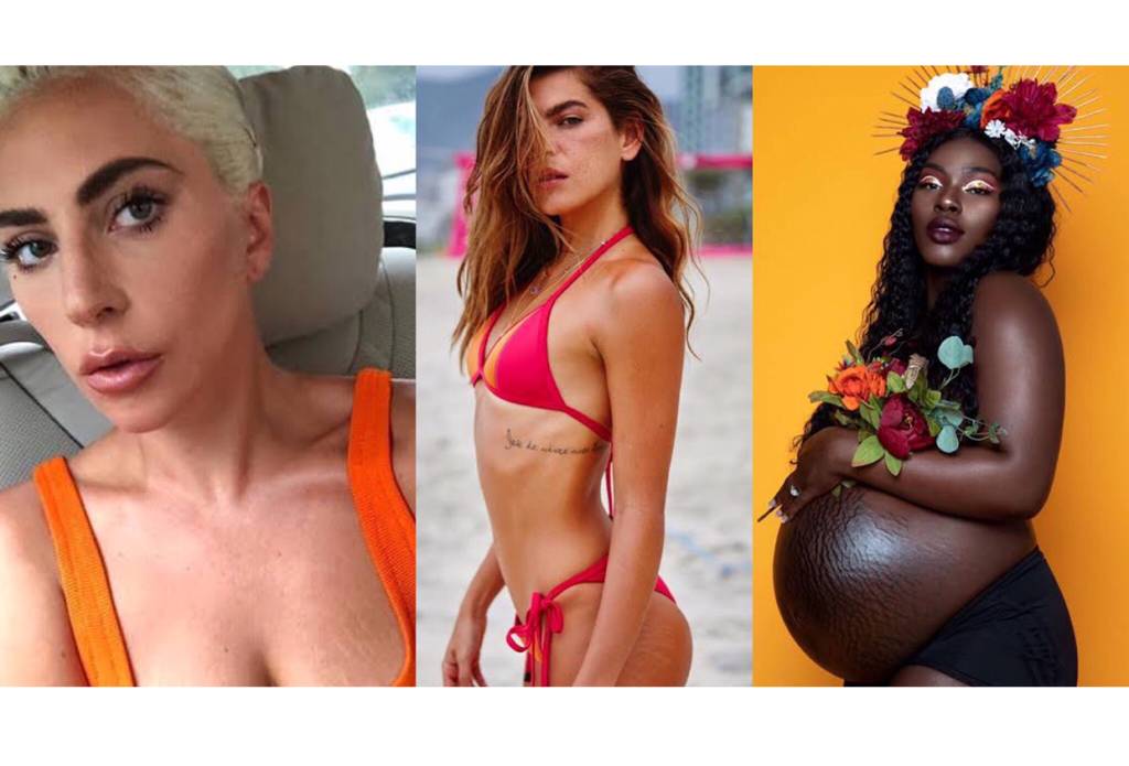 Estrias: o importante é se sentir bem