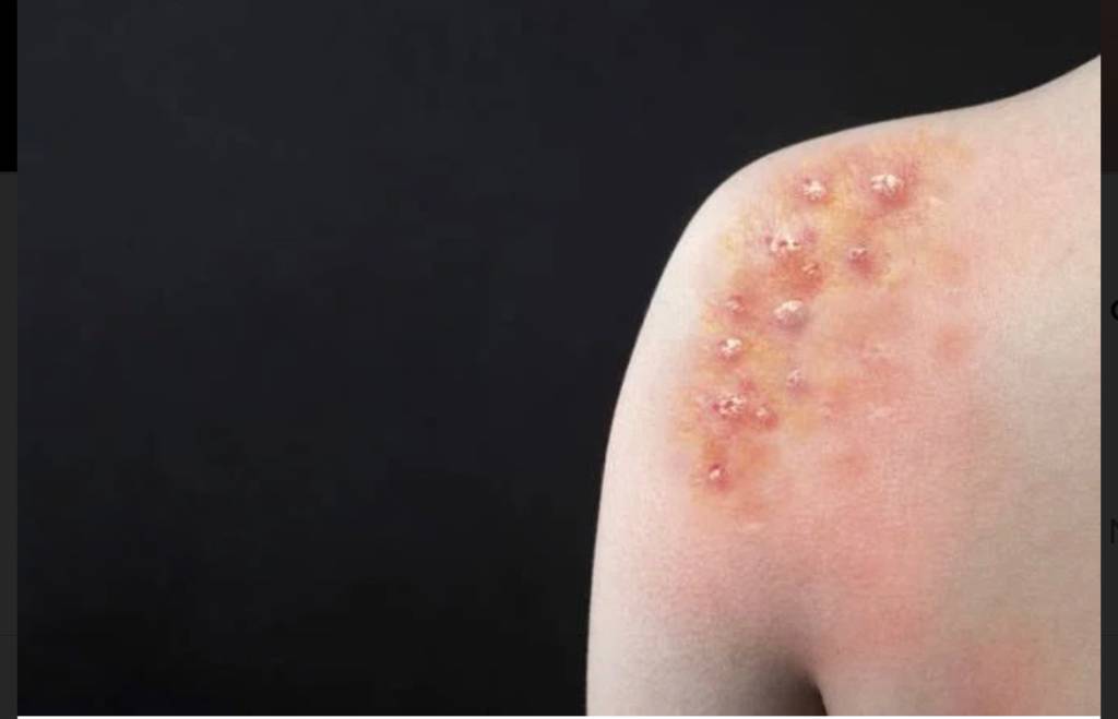 Varíola dos macacos: taxa de positividade chega a 30% em rede privada