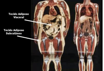 Ressonância magnética demonstrando depósitos de gordura na obesidade no tecido adiposo subcutâneo e no tecido adiposo visceral.