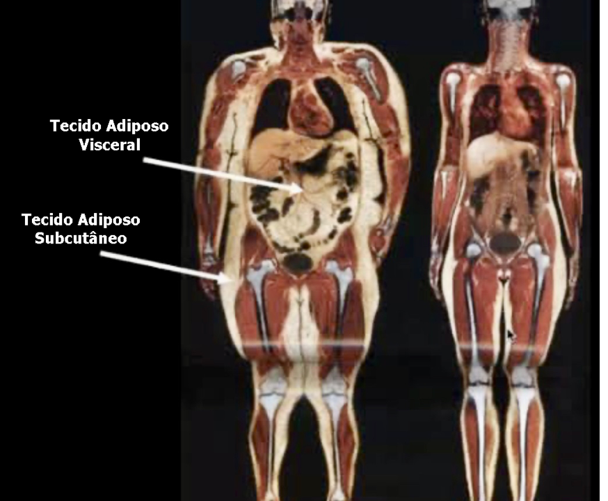 Ressonância magnética demonstrando depósitos de gordura na obesidade no tecido adiposo subcutâneo e no tecido adiposo visceral.