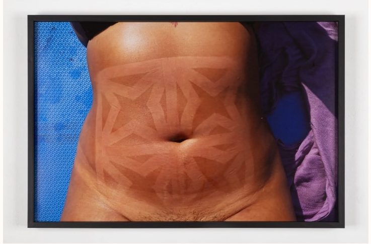 Foto de uma barriga de mulher com "marquinha" típica de uma grade de janela do subúrbio carioca