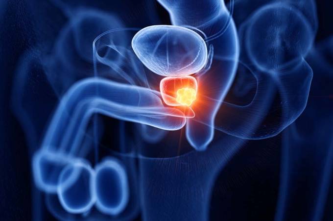 prevencao-do-cancer-de-prostata-confira-os-sintomas