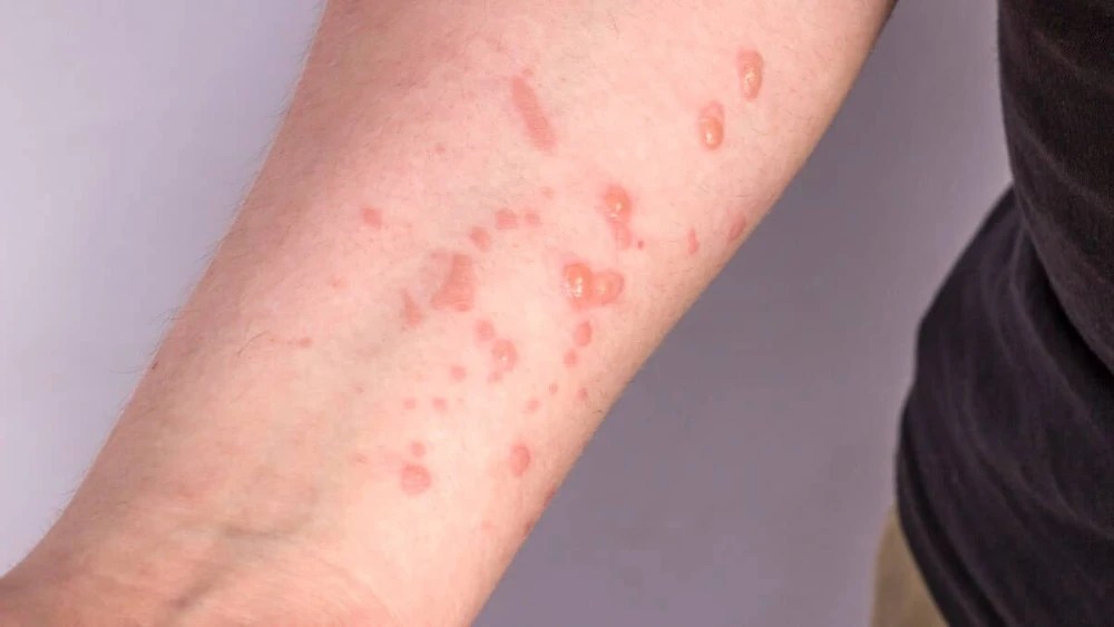 Mpox: entenda a doença