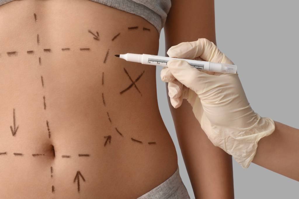 Mommy makeover: Qual o limite das cirurgias plásticas combinadas?